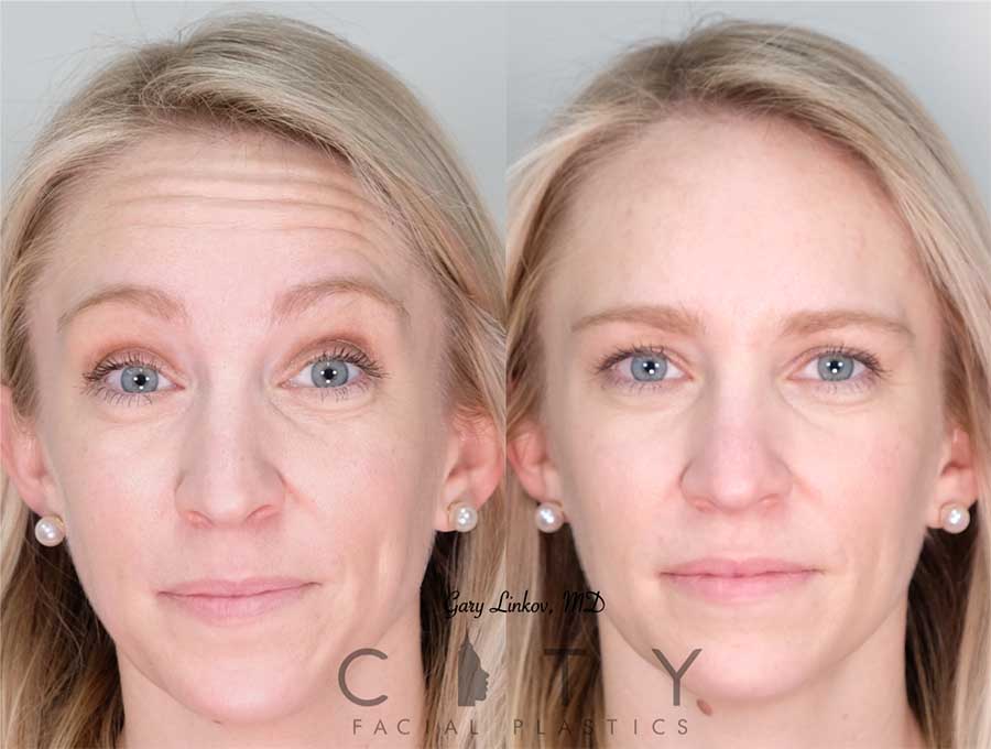 Normal facial asymmetry, nude velma