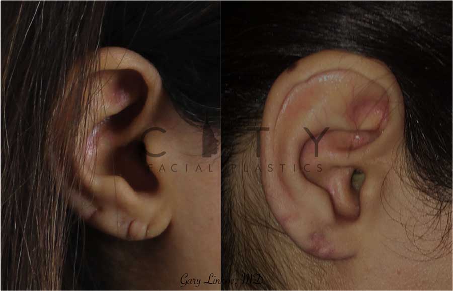 NYC Ear Lobe Repair Before and After Pictures New York UES
