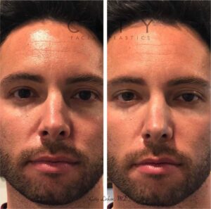 A non-surgical rhinoplasty was able to restore the contours to the left side of his nose. Being on camera, this young man was bothered by the way light hit his nose. Not wanting a surgical solution, he opted for a quick filler injection to give him the look he wanted.