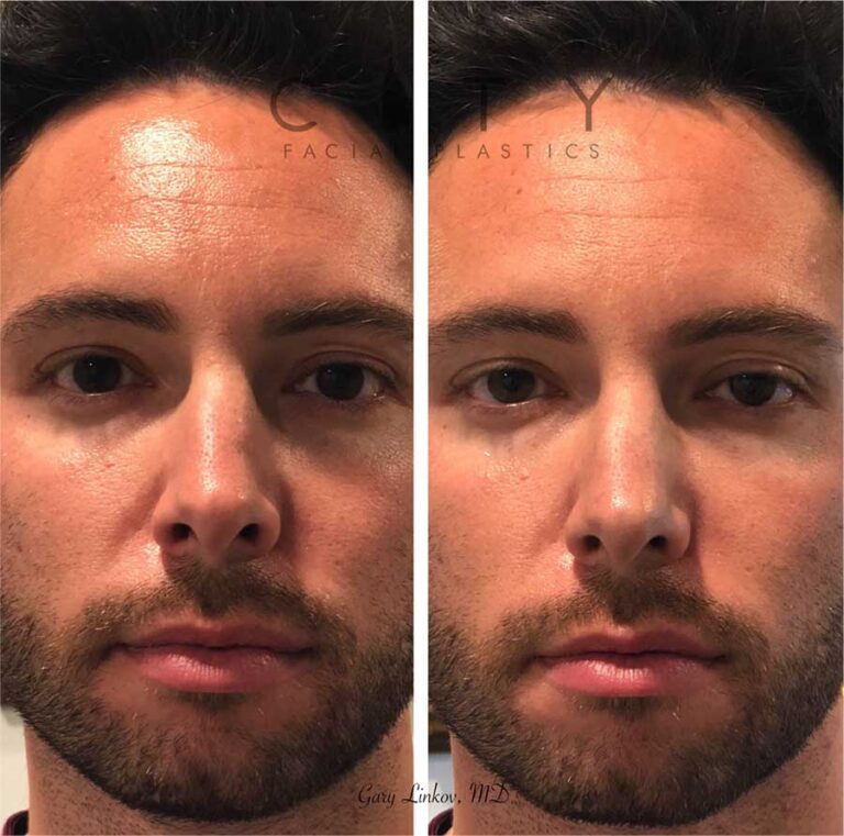 NonSurgical Rhinoplasty NYC Best Liquid Nose Job New