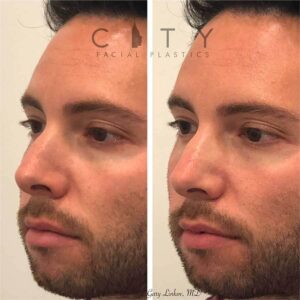 A non-surgical rhinoplasty was able to restore the contours to the left side of his nose. Being on camera, this young man was bothered by the way light hit his nose. Not wanting a surgical solution, he opted for a quick filler injection to give him the look he wanted.