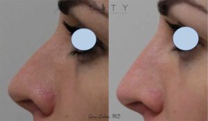 A non-surgical rhinoplasty nicely addressed the dorsum (bridge of the nose) in this young woman, making it more straight and uniform. It took a few minutes and was completely affordable.