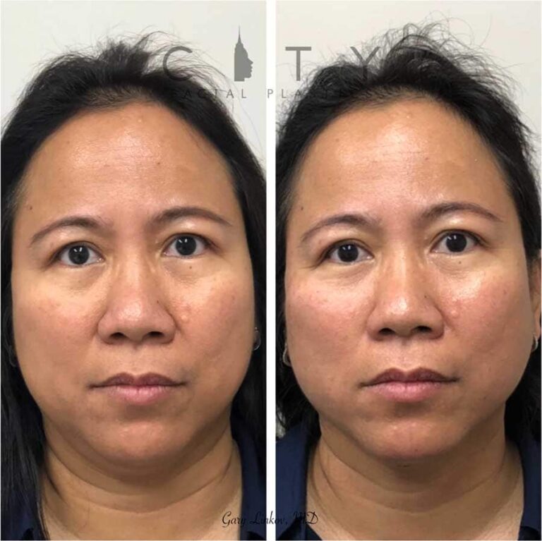 NYC Threadlift Before and After Pictures New York UES