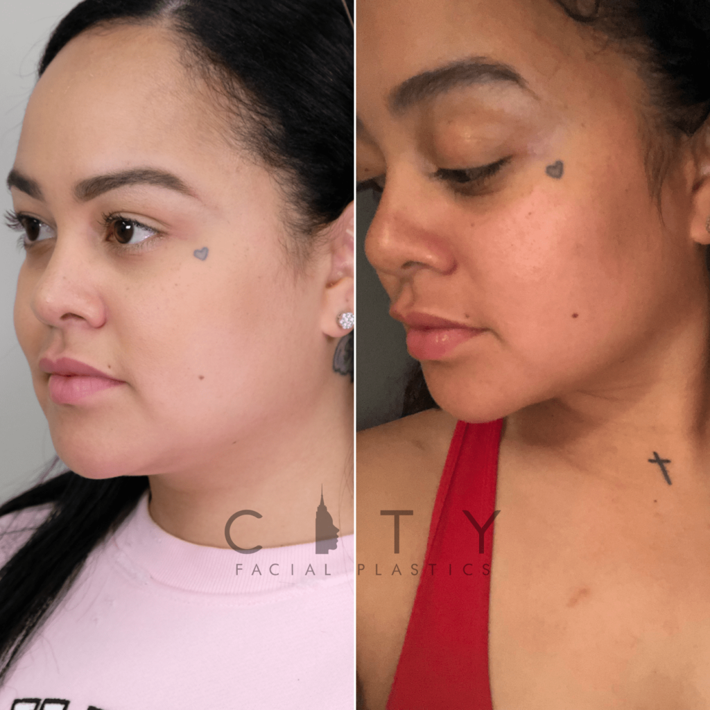 NYC Buccal Fat Removal Before and After Pictures New York UES