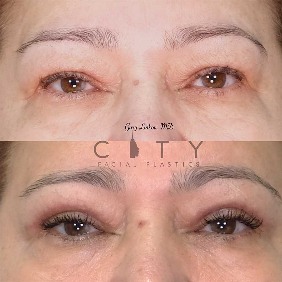 Blepharoplasty Near Me for a More Youthful Appearance