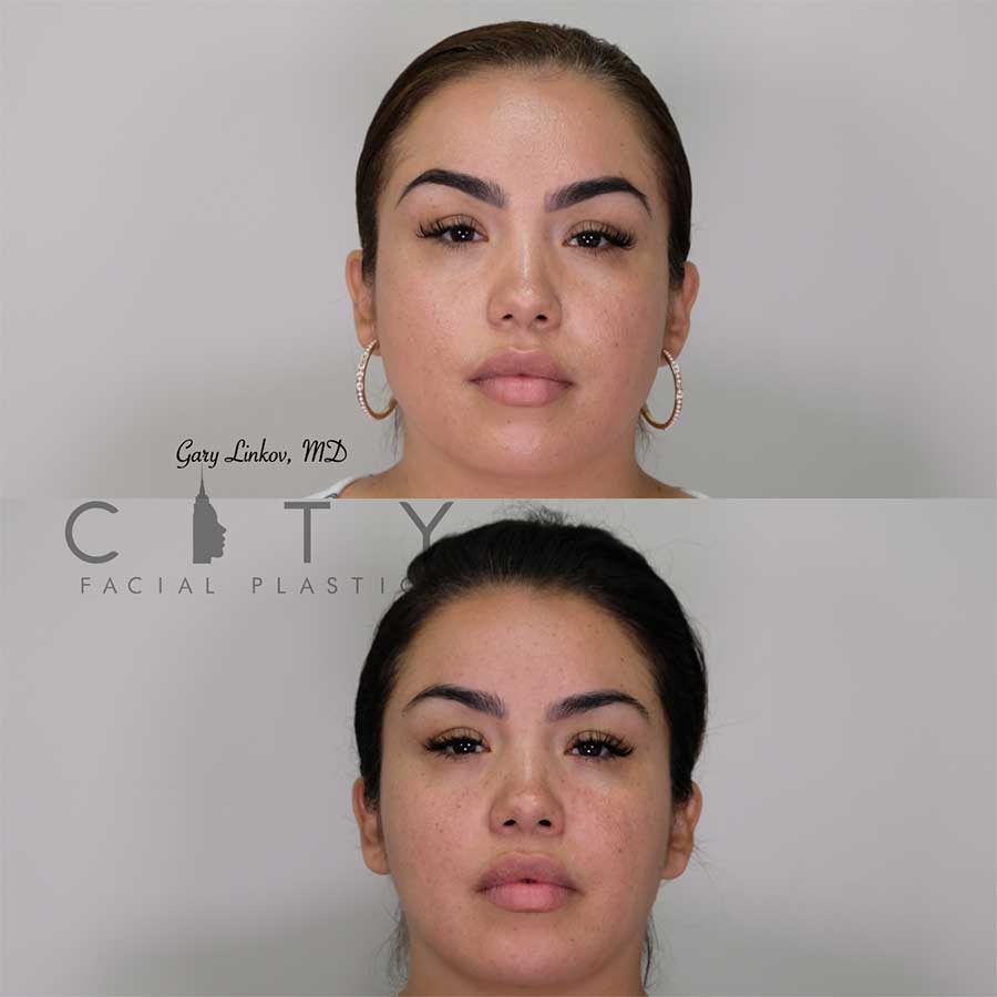 masseter botox