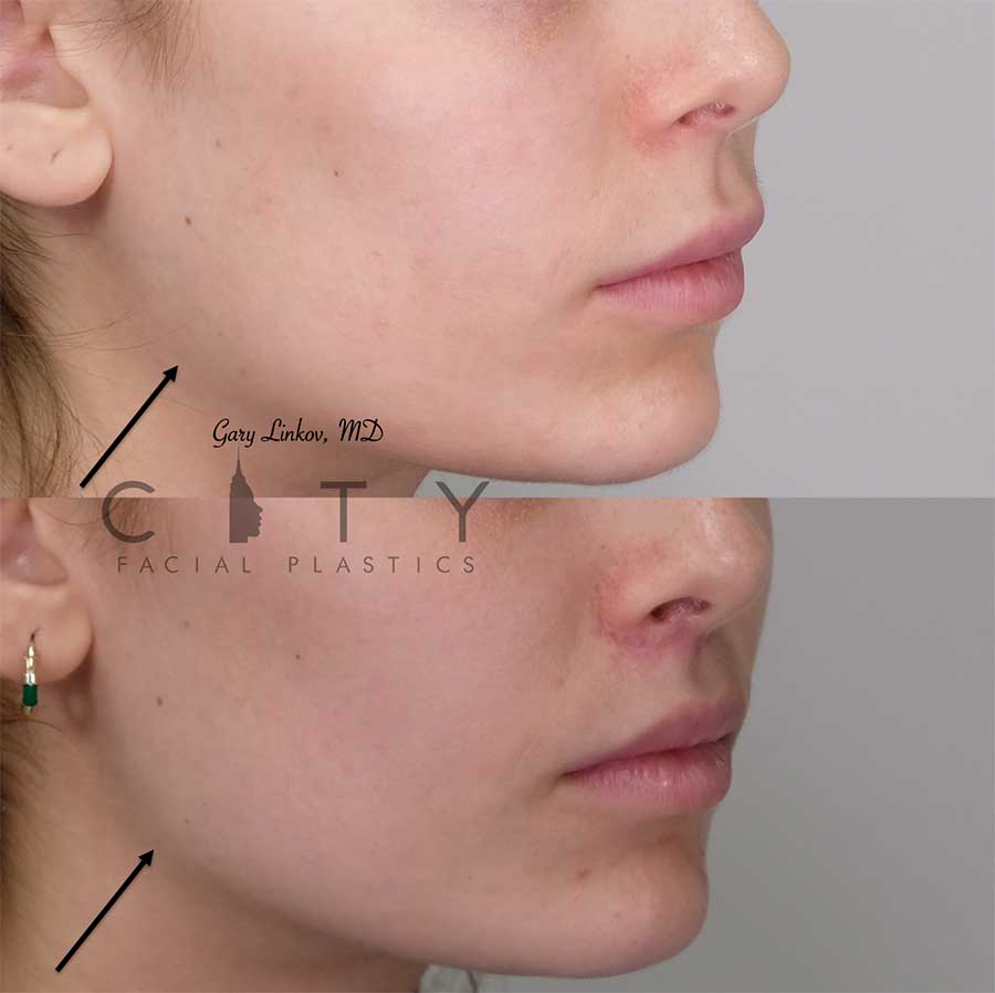 NYC Jawline Filler Before and After Pictures New York UES