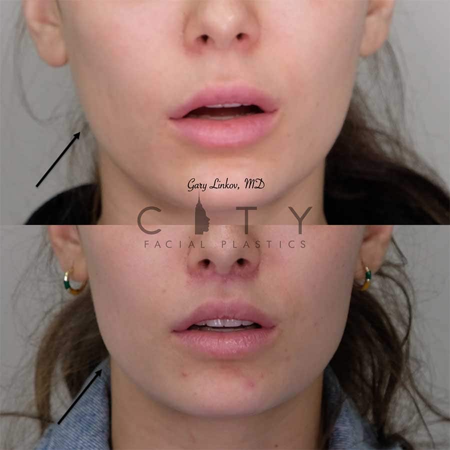 jawline filler before and after