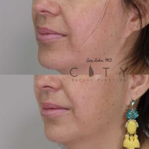 Lip reduction left profile three quarter photo.