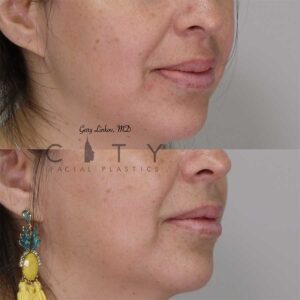 Lip reduction right profile three quarter photo.