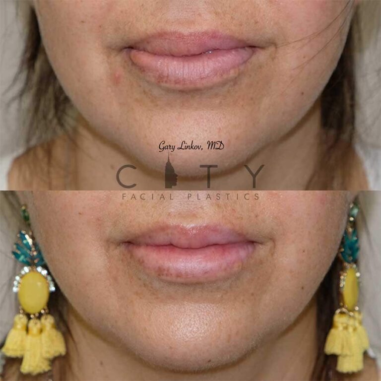Lip Reduction in Manhattan, New York