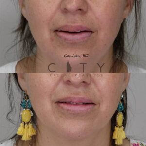 Lip reduction front photo, mouth open.