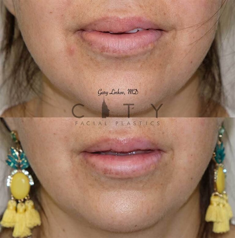 Lip Reduction in Manhattan, New York