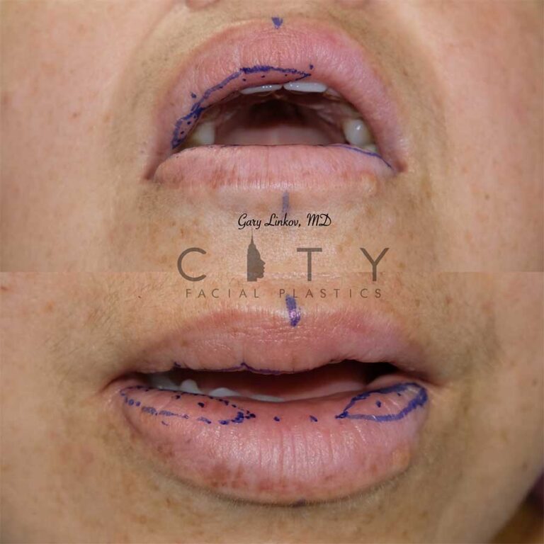 Lip Reduction in Manhattan, New York