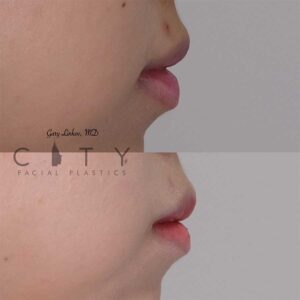 Lip reduction 2 right profile.