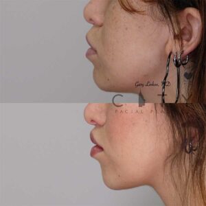 Lip lift 20 left profile