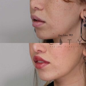 Lip lift 20 left three quarter profile