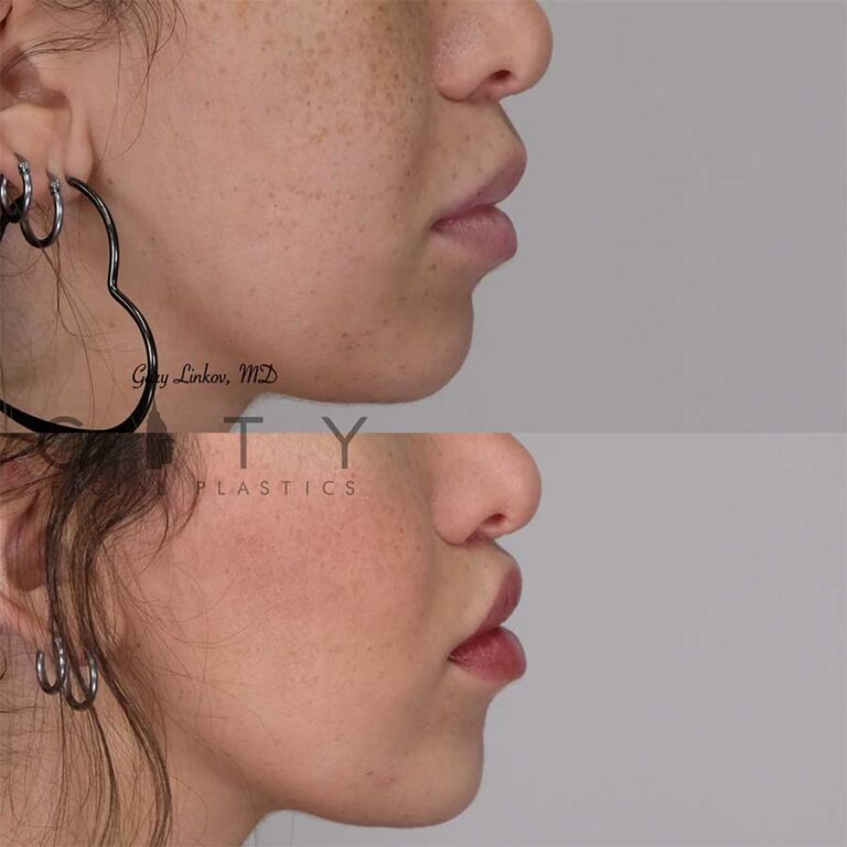 Nyc Philtrum Contouring Lip Lift Dr Gary Linkov Facial Plastic Surgeon 7155