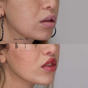 Lip lift 20 right three quarter profile