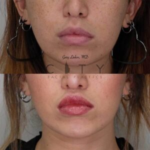 Lip lift 20 frontal mouth closed