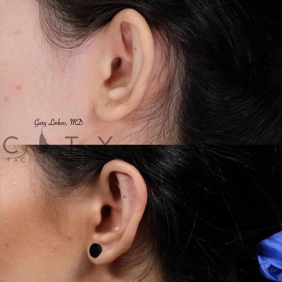 NYC Otoplasty Before and After Pictures New York UES