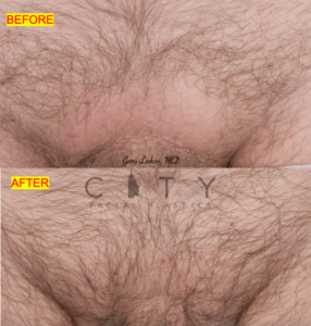 Hair transplant 3 pubic
