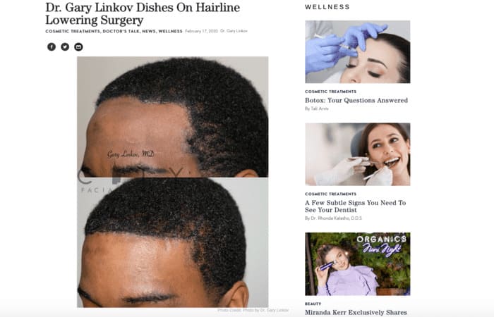 Screenshot of article: Dr. Gary Linkov Dishes On Hairline Lowering Surgery