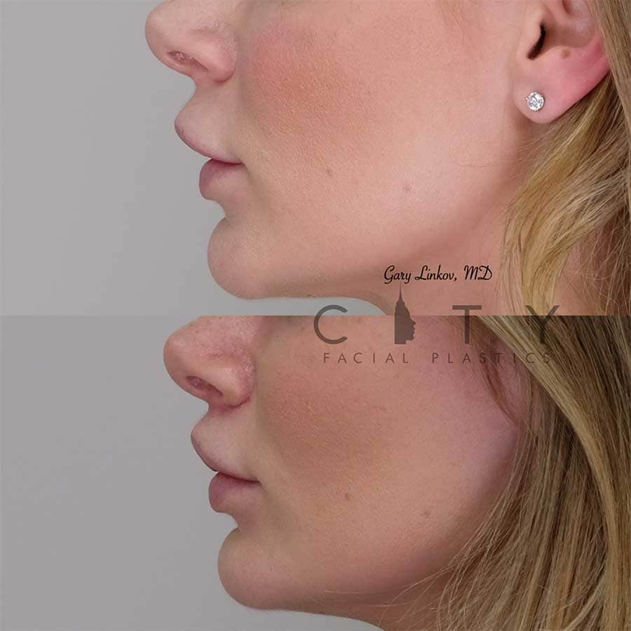 nyc-bullhorn-lip-lift-surgery-new-york-subnasal-lip-enhancement