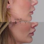 NYC Bullhorn Lip Lift Surgery | New York Subnasal Lip Enhancement