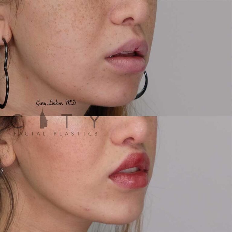 nyc-bullhorn-lip-lift-surgery-new-york-subnasal-lip-enhancement