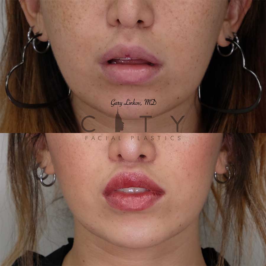NYC Bullhorn Lip Lift Surgery New York Subnasal Lip Enhancement