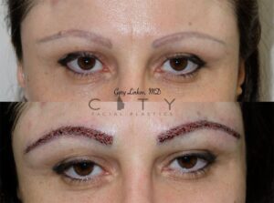Eyebrow Transplant | NYC Facial Plastic Surgery