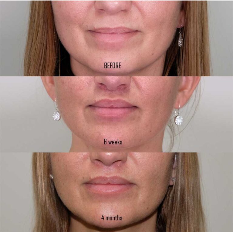 Lip Lift in New York City Upper Lip Lift Surgery Manhattan