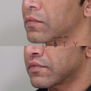 Lip lift 17 left profile three quarter.