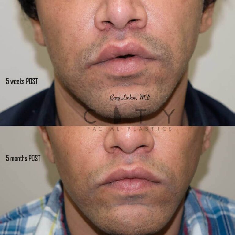 NYC Male Lip Lift | UES Male Lip Enhancement, Augmentation Surgery