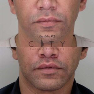 Lip lift 17 frontal mouth closed.