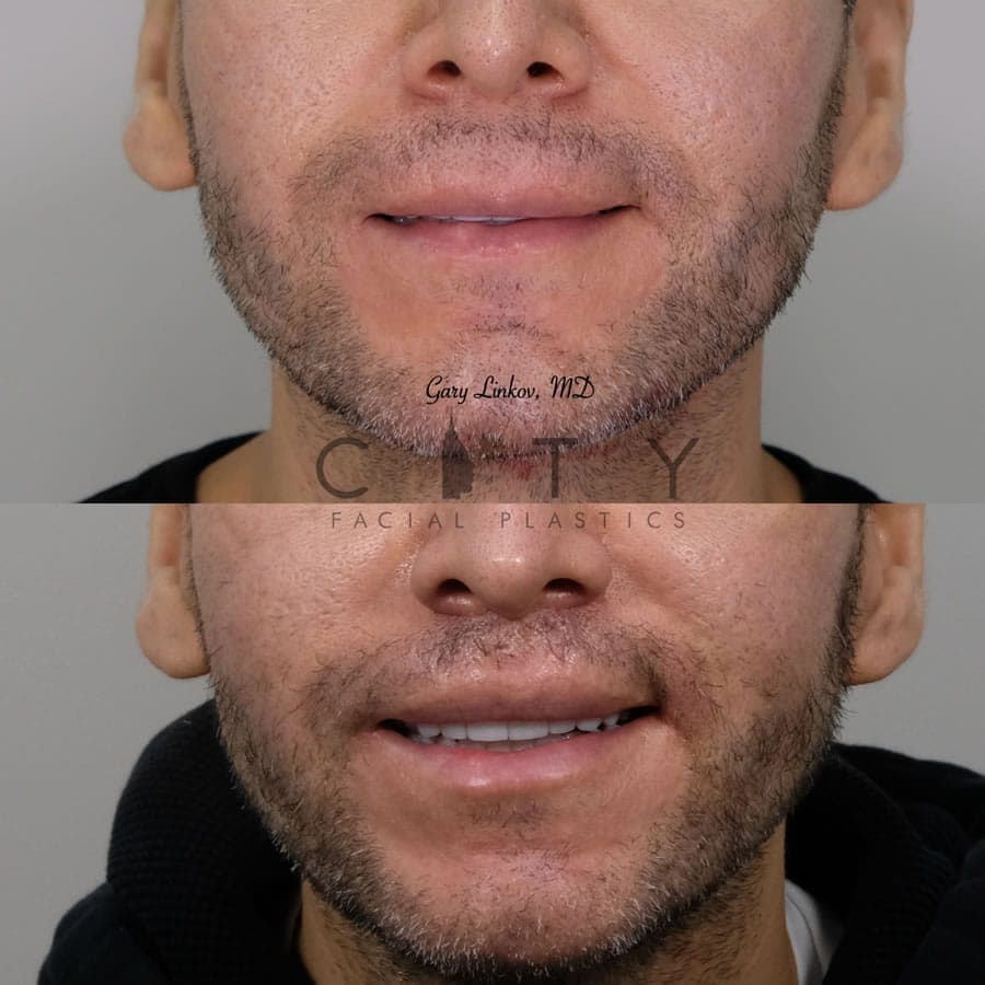 NYC Male Lip Lift | UES Male Lip Enhancement, Augmentation Surgery