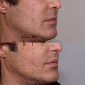 NYC Male Lip Lift | UES Male Lip Enhancement, Augmentation Surgery