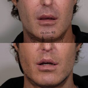 Lip lift 28 frontal mouth open