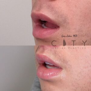 Lip Lift Upper East Side NYC