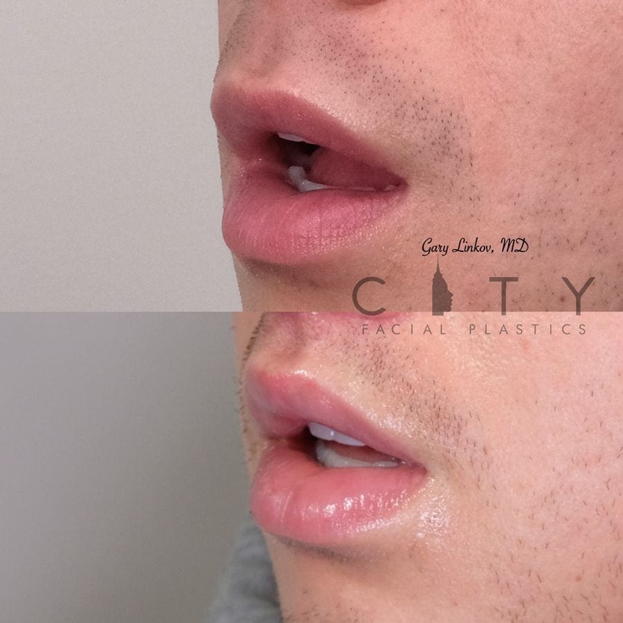 NYC Male Lip Lift | UES Male Lip Enhancement, Augmentation Surgery