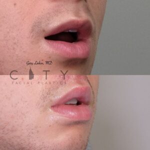 Lip Lift Upper East Side NYC