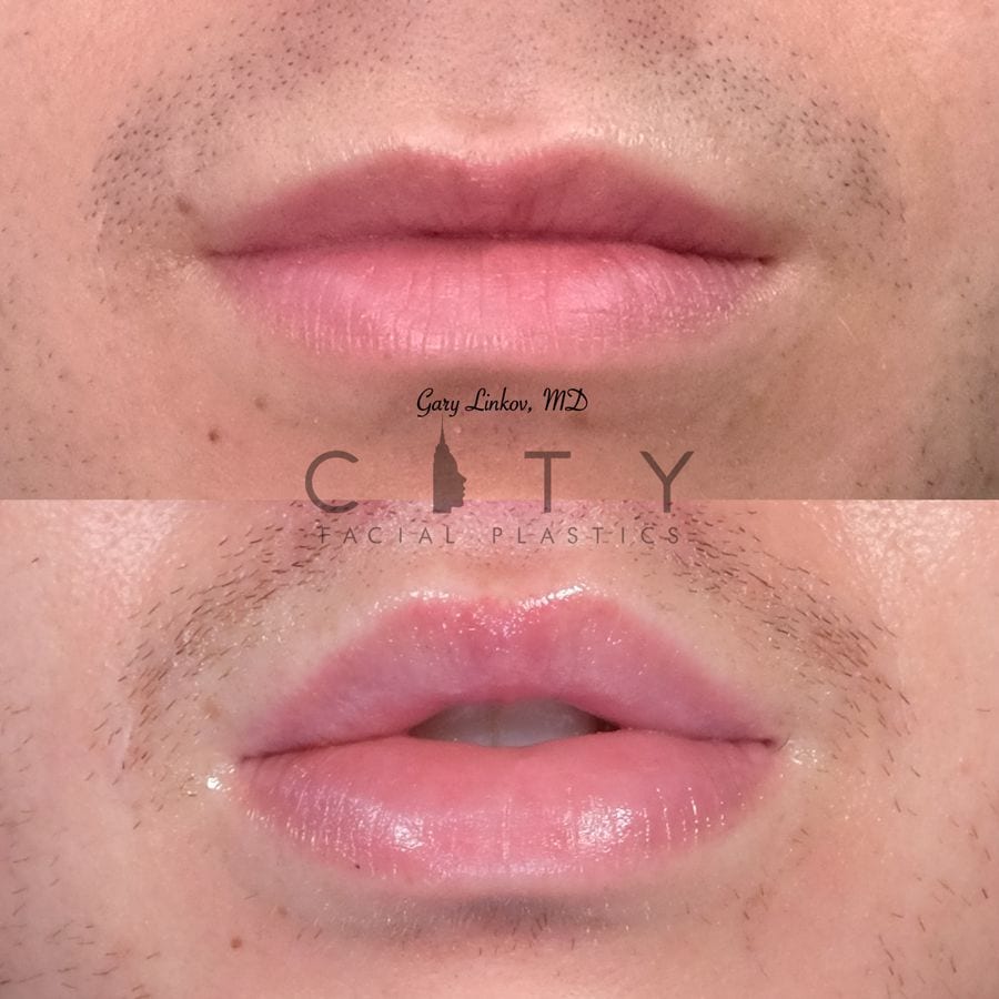 NYC Male Lip Lift UES Male Lip Enhancement Augmentation Surgery