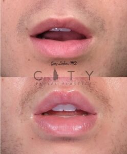 Lip Lift Upper East Side NYC