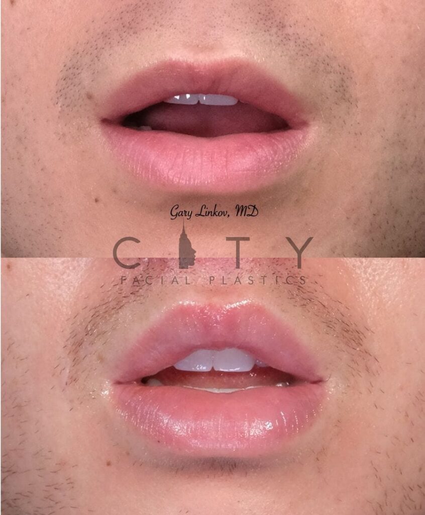 Nyc Male Lip Lift Ues Male Lip Enhancement Augmentation Surgery