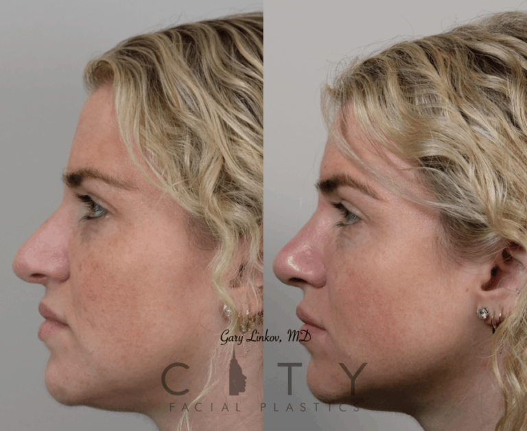 Revision Rhinoplasty NYC | Best Revision Nose Job Manhattan