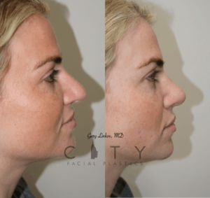 Revision Rhinoplasty Specialist NYC