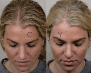 frontal birds case 1