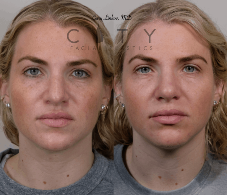 Revision Rhinoplasty NYC | Best Revision Nose Job Manhattan