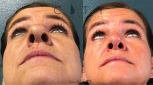Revision rhinoplasty case 2